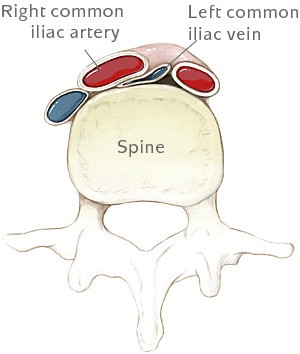May Thurner Syndroom