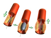 Dotter-stentbehandeling